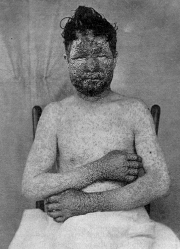 Smallpox Photo