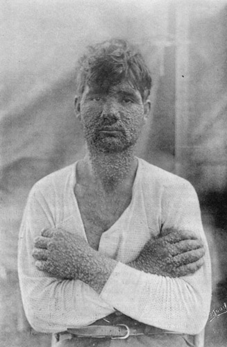 Smallpox Photo