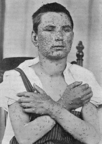 Smallpox Photo
