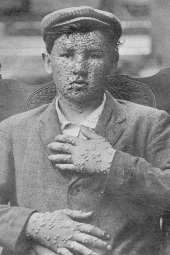 Smallpox Photo