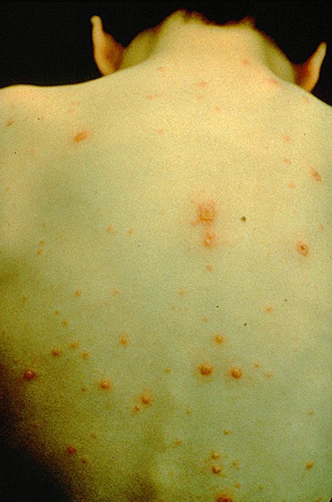 Varicella Chicken Pox Picture Image on MedicineNet.com