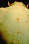 Boy with Chickenpox