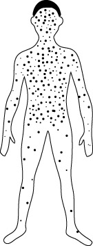 Chickenpox Rash