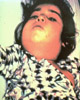 Boy with Diphtheria
