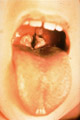 Diphtheria