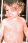 Baby with Measles