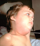 Boy with Mumps