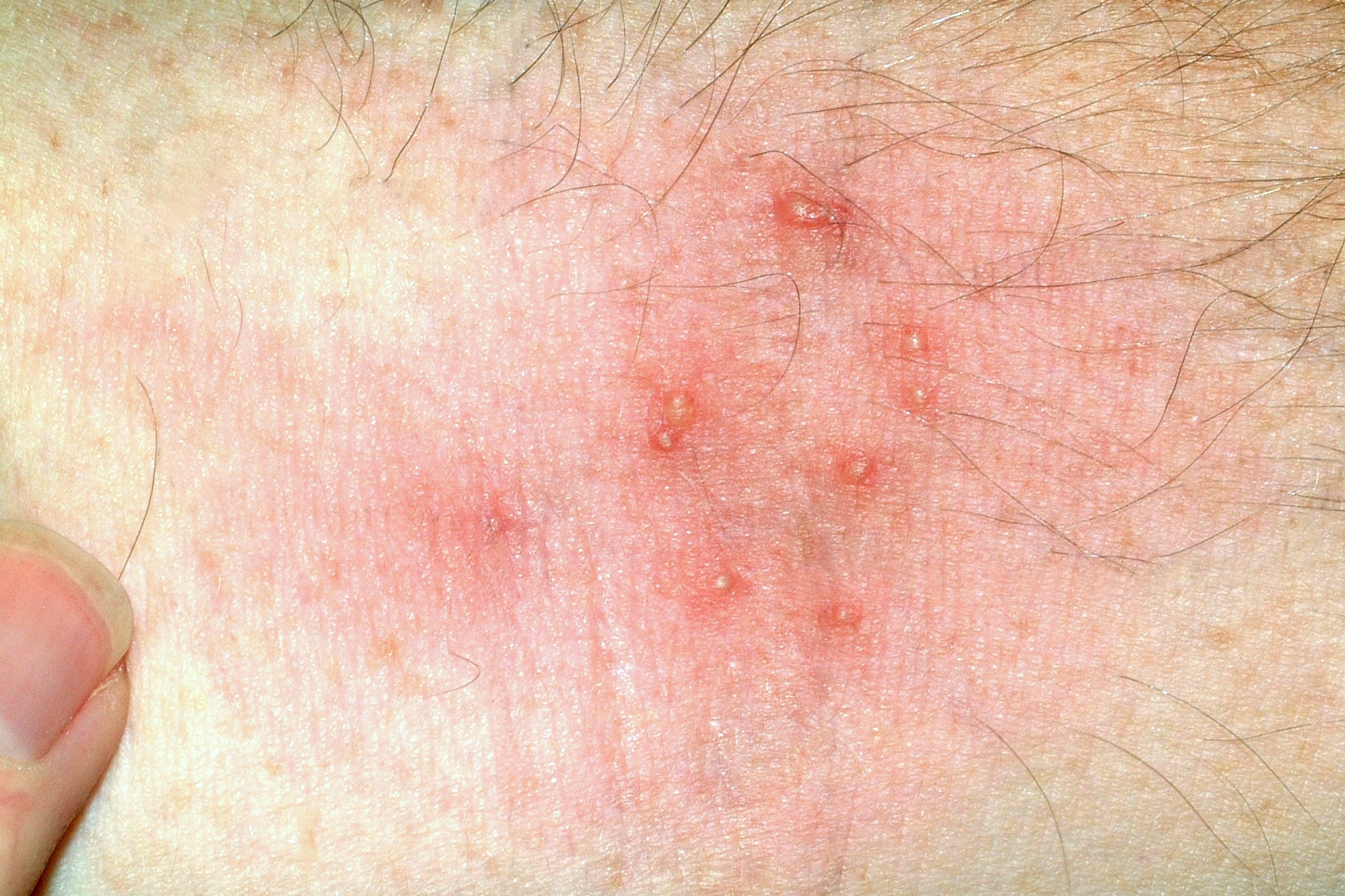 Scabies - Wikipedia