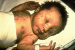 Baby with Rubella