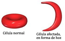 Image result for hemoglobina falciforme