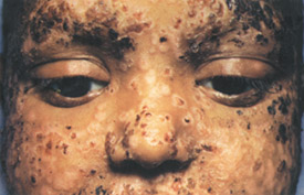 Smallpox day 7