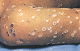 Picture of Varicella Chickenpox - WebMD