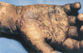 smallpox_day15hand.jpg