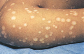 Smallpox day 10