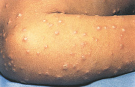 Smallpox day 5