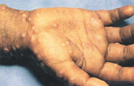 Smallpox day 5