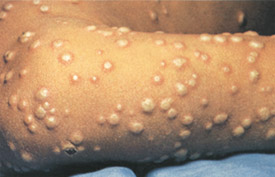 Smallpox day 7