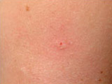 Smallpox Vaccine Process