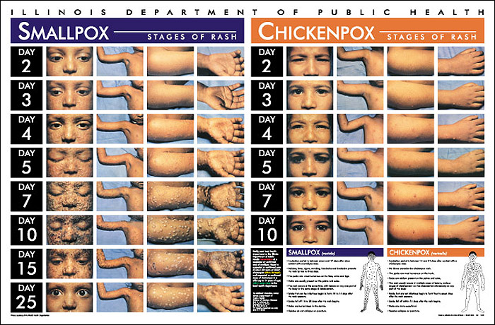 Chicken Pox Images To Identify Stages Of The Rash | How To ...