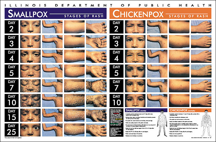 Chicken Pox Pictures | MedicalPictures.net