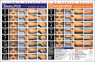 Smallpox vs. Chickenpox