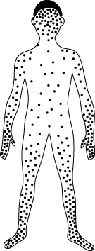 Smallpox Rash