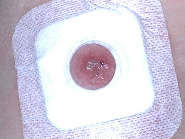 Smallpox Vaccinations in Illinois