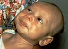 Boy with Tetanus